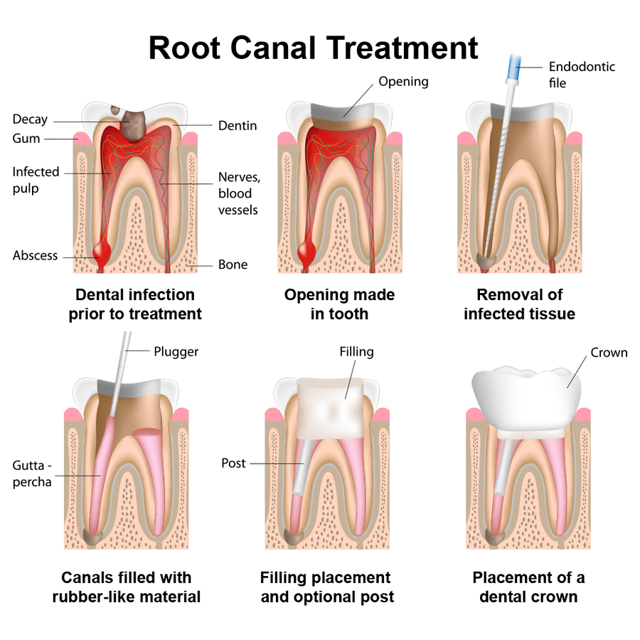 How Endodontics Is Performed_1