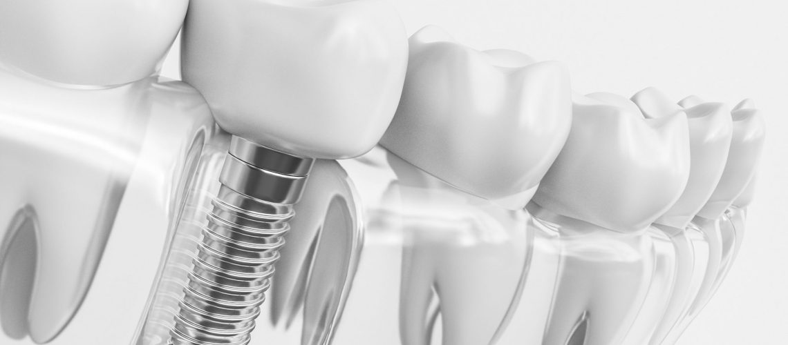 Dental Implant