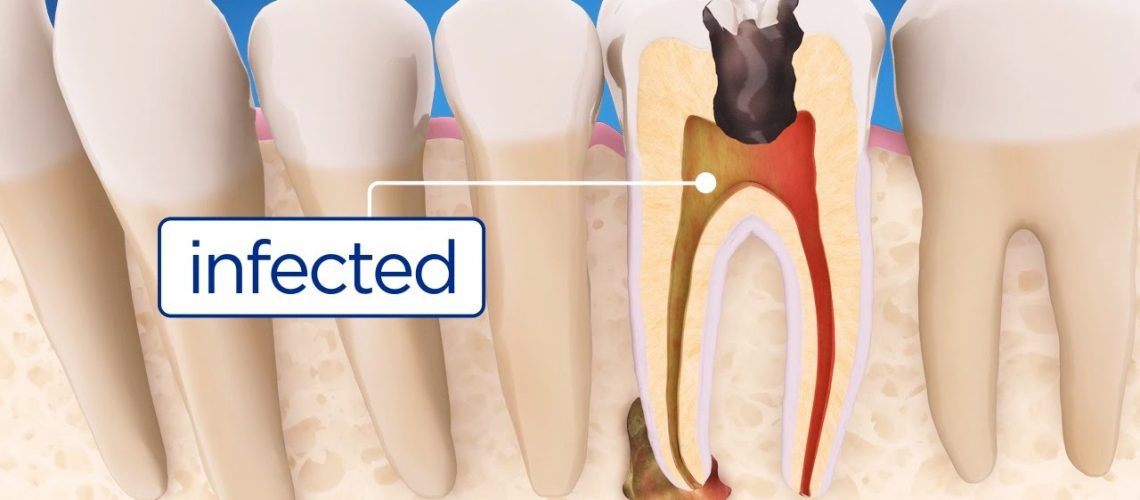 How Endodontics Is Performed